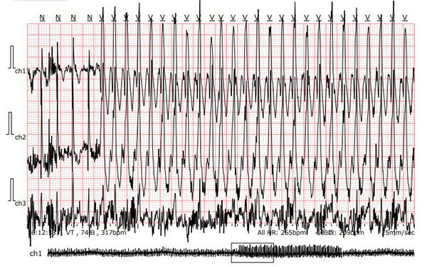 ホルター心電図検査によるBCM(ARVC)の不整脈
