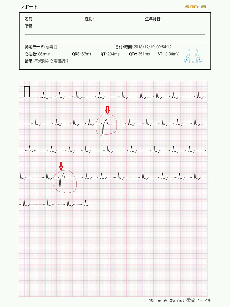 ドーベルマンの拡張型心筋症