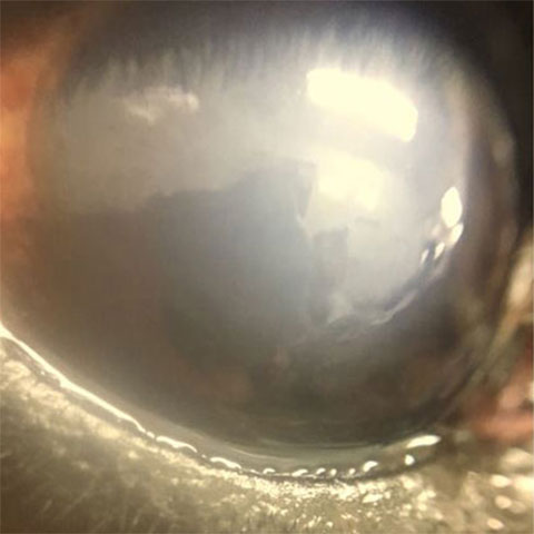 角膜内皮ジストロフィー