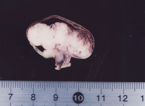 子宮頸部の腫瘍