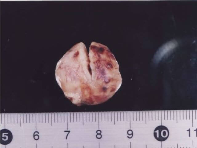 卵巣腫瘍(悪性顆粒膜細胞腫)