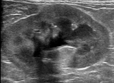 慢性腎障害(形が萎んだように変形する)
