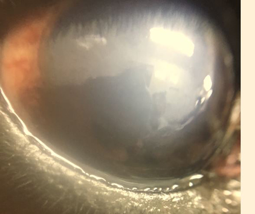 角膜内皮ジストロフィー