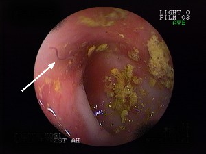 大腸の検査