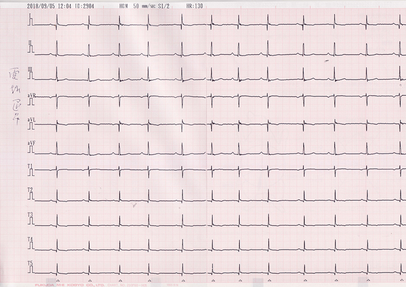 11誘導心電図検査